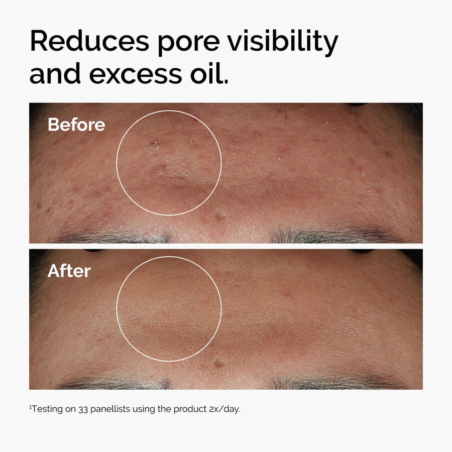 niacinamide-10-zinc-1-p7 ord-niacinamide-zinc-blemish-serum-before-after-pores.jpg