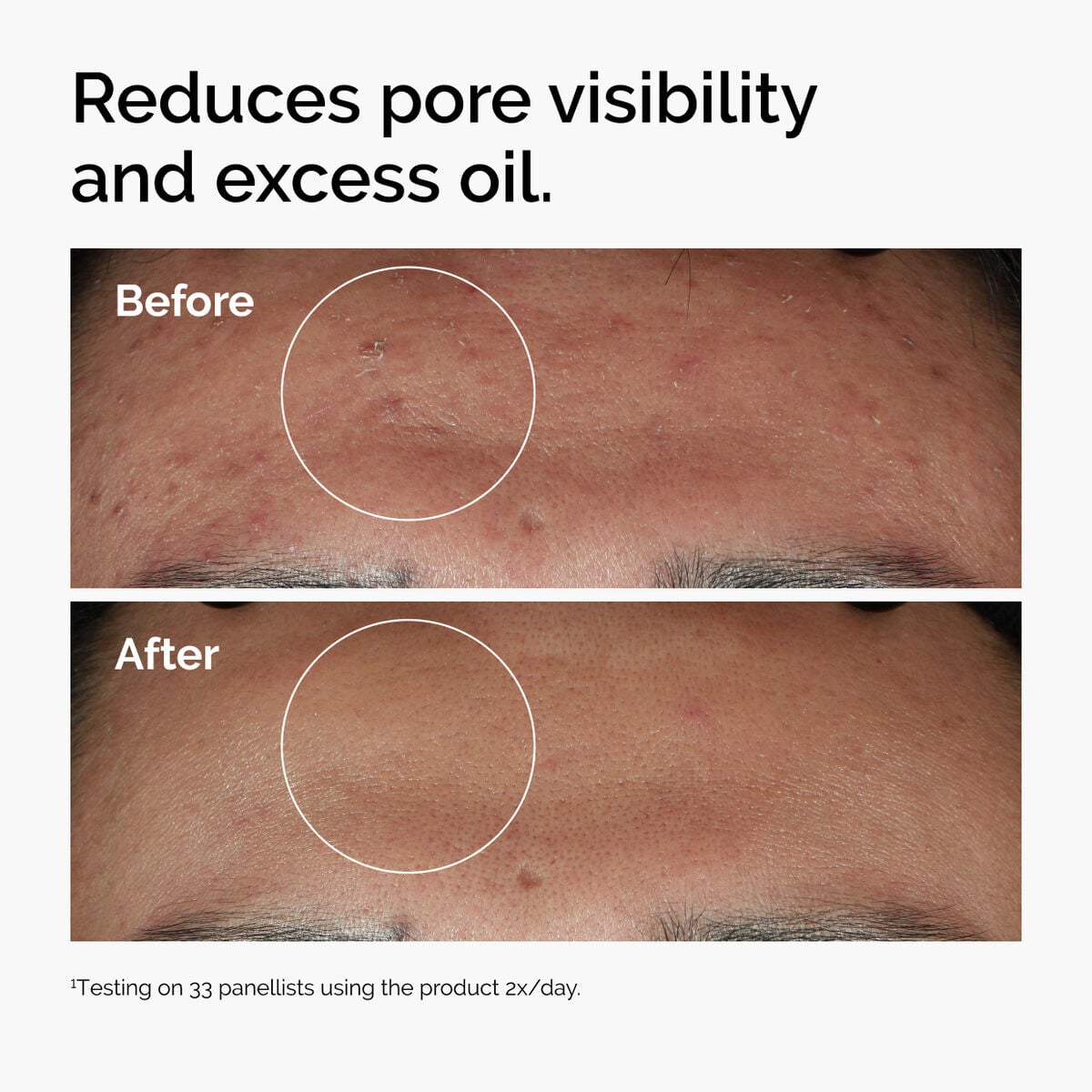 niacinamide-10-zinc-1-p7 ord-niacinamide-zinc-blemish-serum-before-after-pores.jpg