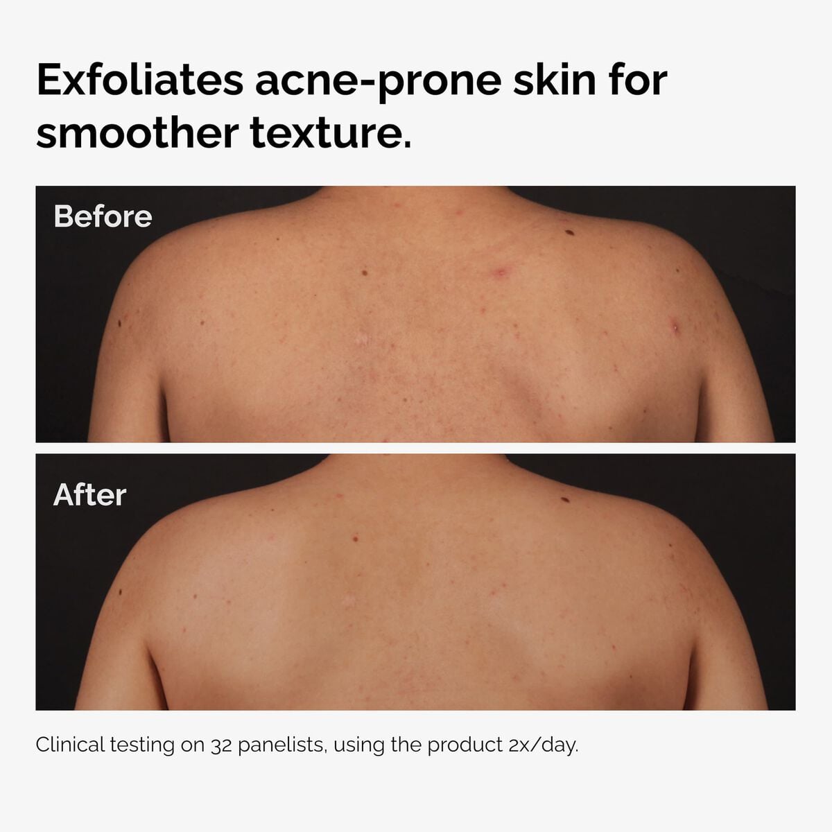 salicylic-acid-0-5-body-serum-s7 ord-salicylic-acid-body-serum-before-after-graphic-NA.jpg
